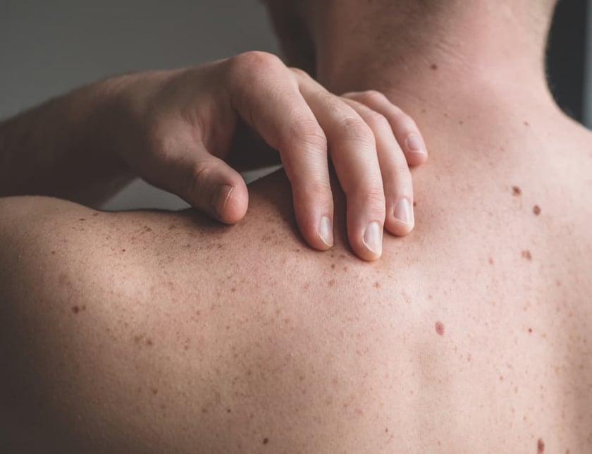 Close up detail of the bare skin on a man back with scattered moles and freckles. 