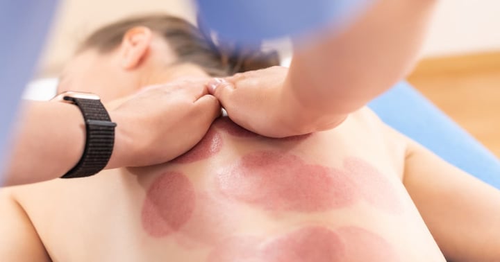 Therapist massaging female patient after cupping therapy. 